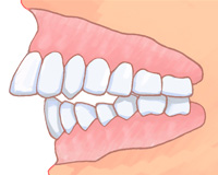 出っ歯、上の歯が出ている(上顎前突)