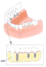 部分入れ歯と比較したインプラント治療