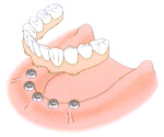 総入れ歯と比較したインプラント治療